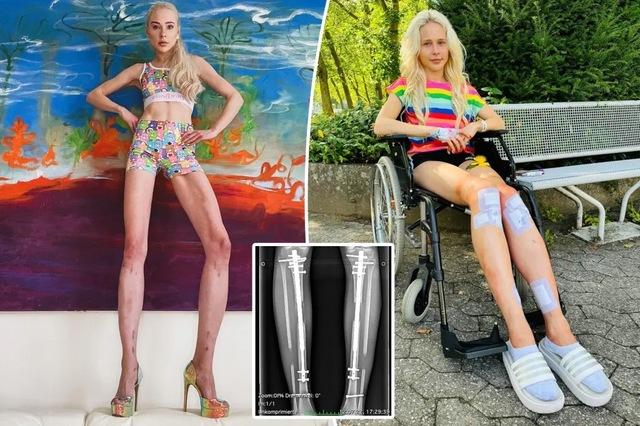 From 5.5 Inches Taller to Years of Pain: The Shocking Downfall of Theresia Fischer